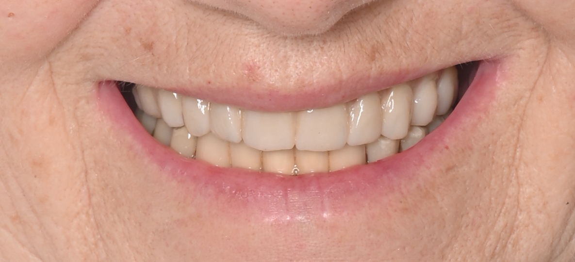 implant coroane zirconiu